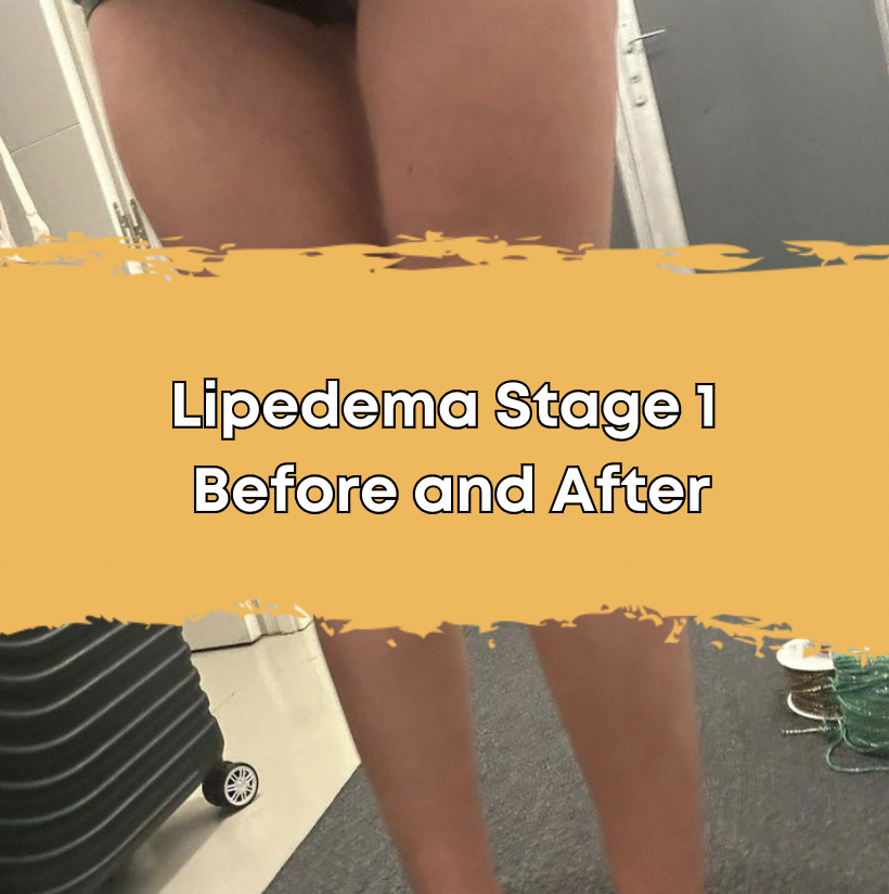 Lipedema Stage 1 Before and After