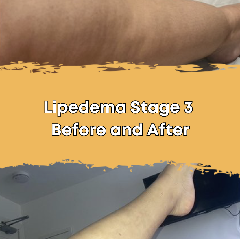 Lipedema Stage 3 Before and After