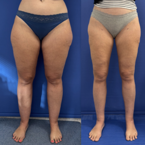 Renuvion during Lipedema surgery