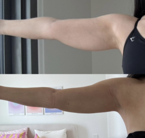 Renuvion Skin Tightening on Arms