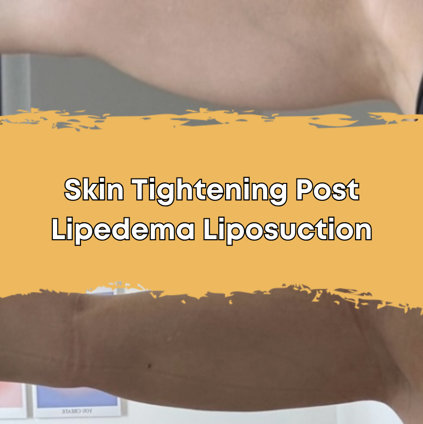 Skin Tightening Post Lipedema Liposuction