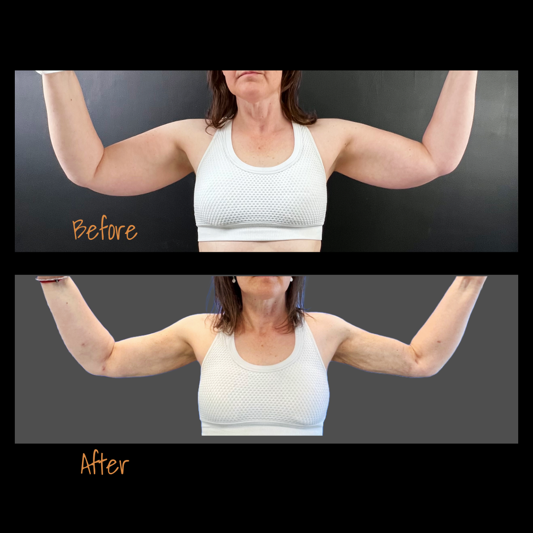 VASER Liposuction on Arms