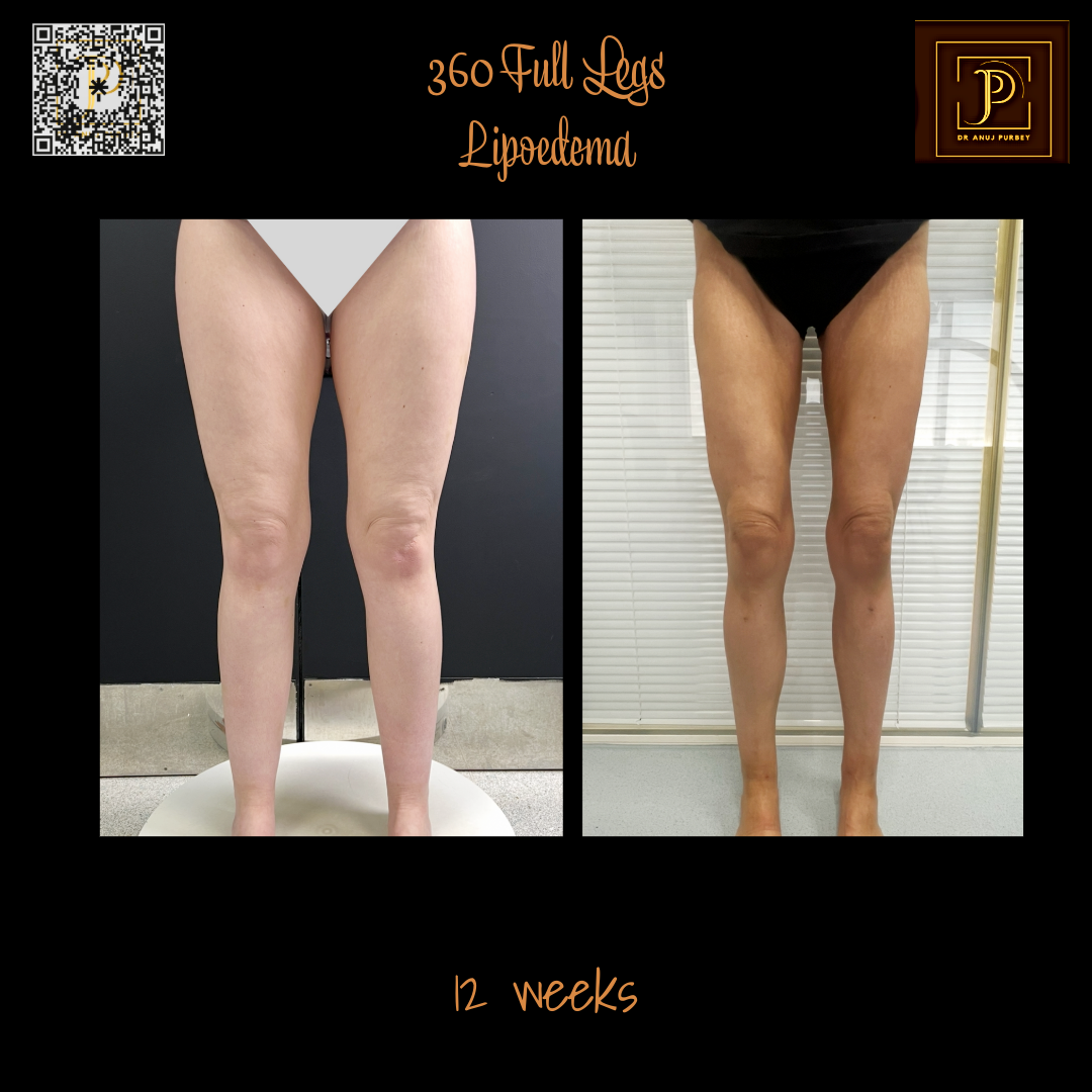 VASER Liposuction - Before and After